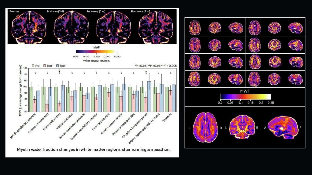 Scientific illustration of microglia patrolling neurons alongside MRI showing temporary myelin changes after marathon running